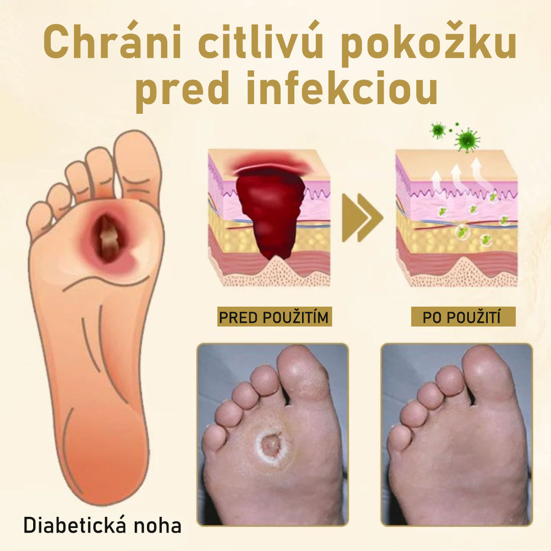 𝐶𝑉𝑅𝐸𝑂𝑍® 𝑆𝑝𝑟𝑒𝑗 𝑛𝑎 𝑙𝑖𝑒č𝑏𝑢 𝑑𝑖𝑎𝑏𝑒𝑡𝑖𝑐𝑘𝑒𝑗 𝑛𝑜ℎ𝑦 𝑠 𝑣č𝑒𝑙í𝑚 𝑗𝑒𝑑𝑜𝑚 🔥 𝐿𝑖𝑚𝑖𝑡𝑜𝑣𝑎𝑛á 𝑝𝑜𝑛𝑢𝑘𝑎 - 𝑧ľ𝑎𝑣𝑎 60 % 🔥
