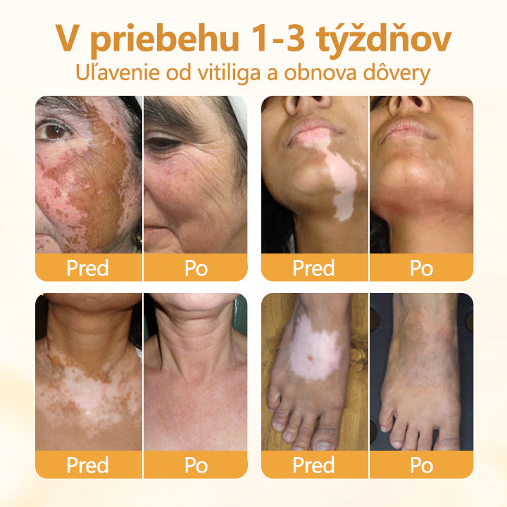 𝑇𝑖𝑚𝑖𝑙𝑘®✅ 𝑉𝑖𝑡𝑖𝐶𝑎𝑙𝑚 – 𝑉𝑖𝑑𝑖𝑡𝑒ľ𝑛é 𝑧𝑙𝑒𝑝š𝑒𝑛𝑖𝑒 𝑣𝑖𝑡𝑖𝑙𝑖𝑔𝑎 𝑢ž 𝑧𝑎 7 𝑑𝑛í! 𝑍𝑏𝑎𝑣𝑡𝑒 𝑠𝑎 𝑏𝑖𝑒𝑙𝑦𝑐ℎ š𝑘𝑣ŕ𝑛 𝑏𝑒𝑧 𝑐ℎ𝑒𝑚𝑖𝑘á𝑙𝑖í.