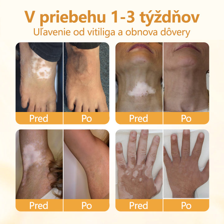 𝑇𝑖𝑚𝑖𝑙𝑘®✅ 𝑉𝑖𝑡𝑖𝐶𝑎𝑙𝑚 – 𝑉𝑖𝑑𝑖𝑡𝑒ľ𝑛é 𝑧𝑙𝑒𝑝š𝑒𝑛𝑖𝑒 𝑣𝑖𝑡𝑖𝑙𝑖𝑔𝑎 𝑢ž 𝑧𝑎 7 𝑑𝑛í! 𝑍𝑏𝑎𝑣𝑡𝑒 𝑠𝑎 𝑏𝑖𝑒𝑙𝑦𝑐ℎ š𝑘𝑣ŕ𝑛 𝑏𝑒𝑧 𝑐ℎ𝑒𝑚𝑖𝑘á𝑙𝑖í.