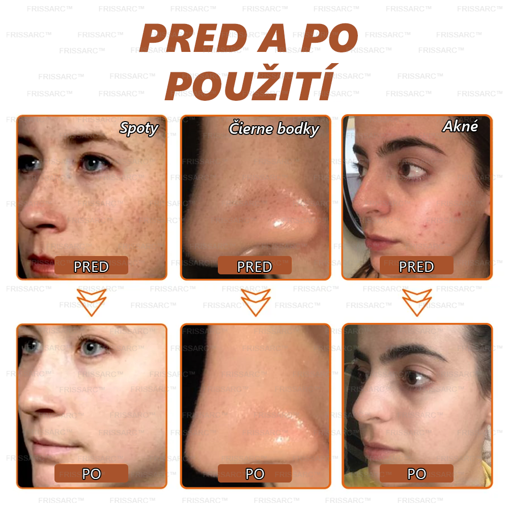 Gratulujeme!💎 Ste jednou z prvých 200 šťastných zákazníčok dneška a získavate špeciálnu zľavu 70 %! Rýchlo odstraňuje pigmentové škvrny a obnovuje mladistvý vzhľad pokožky!