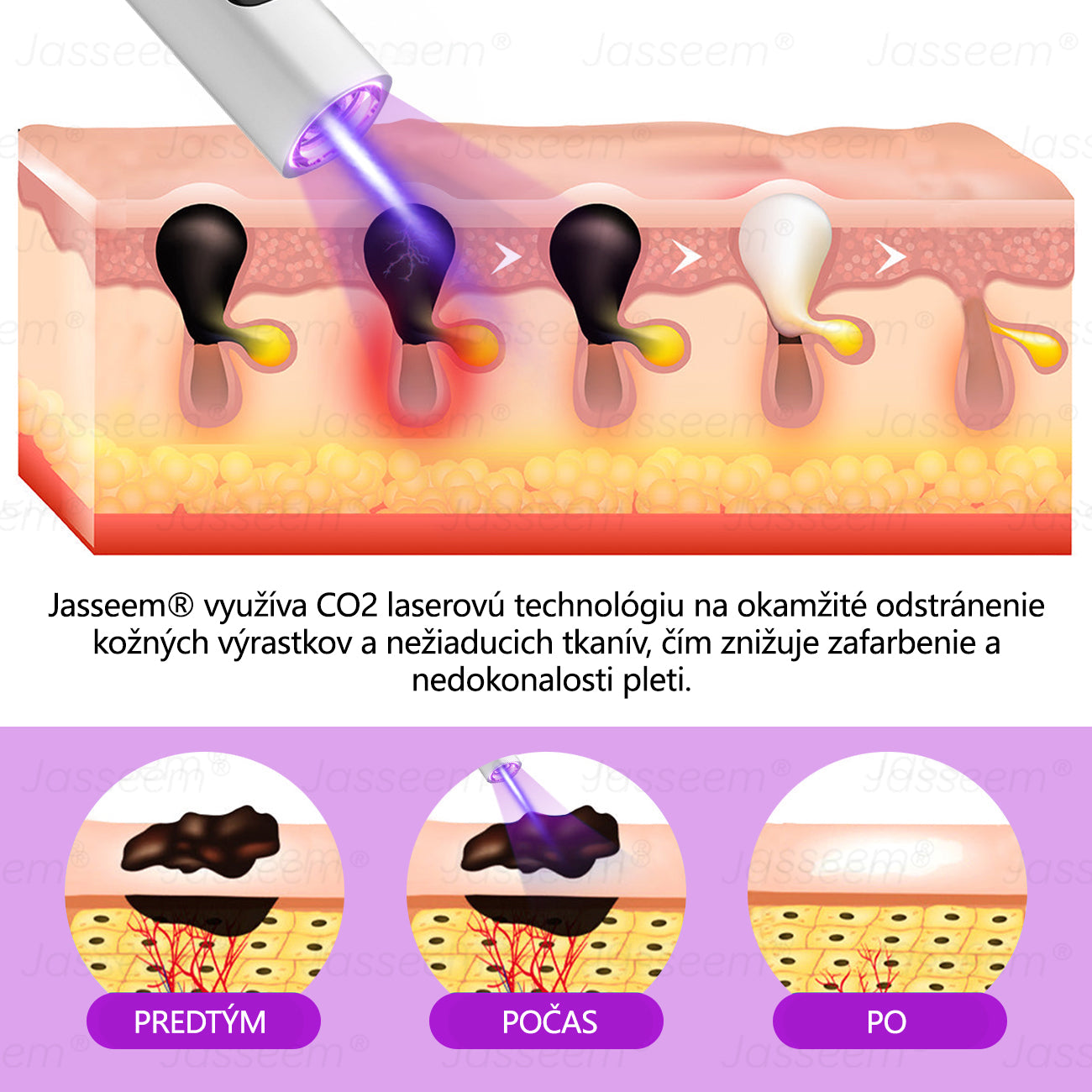 𝐉𝐚𝐬𝐬𝐞𝐞𝐦® ✅Pokročilé neinvazívne CO₂ laserové pero na opravu pokožky 💕 (Jemne odstraňuje bradavice, materské znamienka, starecké škvrny a kožné výrastky – bez bolesti, bez starostí!)
