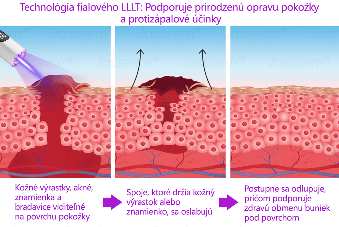 𝐉𝐚𝐬𝐬𝐞𝐞𝐦® ✅Pokročilé neinvazívne CO₂ laserové pero na opravu pokožky 💕 (Jemne odstraňuje bradavice, materské znamienka, starecké škvrny a kožné výrastky – bez bolesti, bez starostí!)