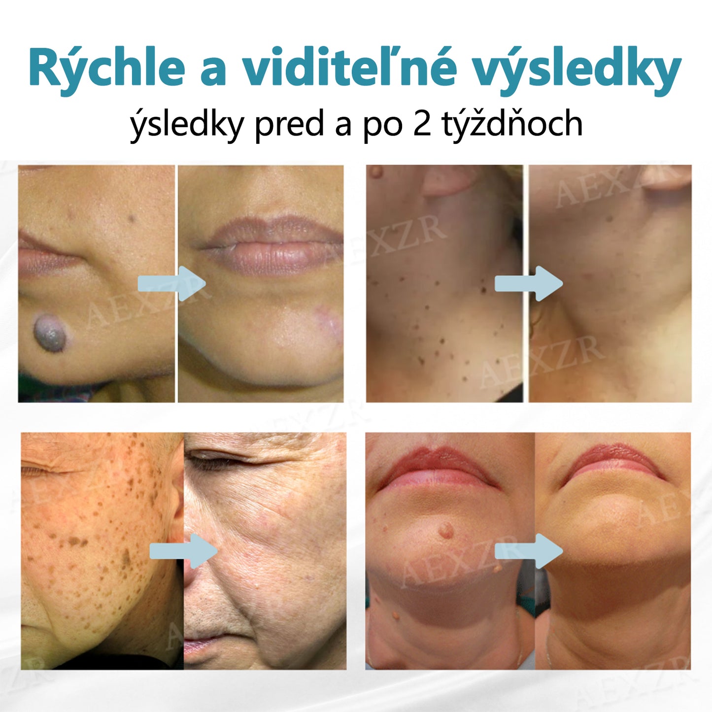 🎉 50 % zľava len na obmedzený čas! Bikenda® Neinvazívne laserové pero Bezbolestné odstránenie znamienok, bradavíc a škvŕn priamo u vás doma! 💕ie znamienok, bradavíc a škvŕn priamo u vás doma! 💕