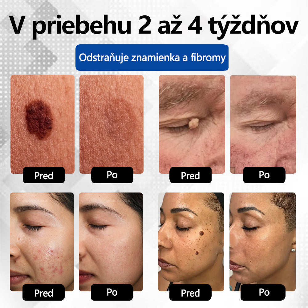 RICPIND®✨ Neinvazívne laserové pero na odstránenie znamienok a bradavíc