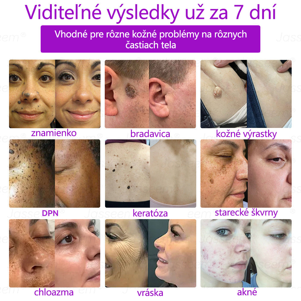 𝐉𝐚𝐬𝐬𝐞𝐞𝐦® ✅Pokročilé neinvazívne CO₂ laserové pero na opravu pokožky 💕 (Jemne odstraňuje bradavice, materské znamienka, starecké škvrny a kožné výrastky – bez bolesti, bez starostí!)