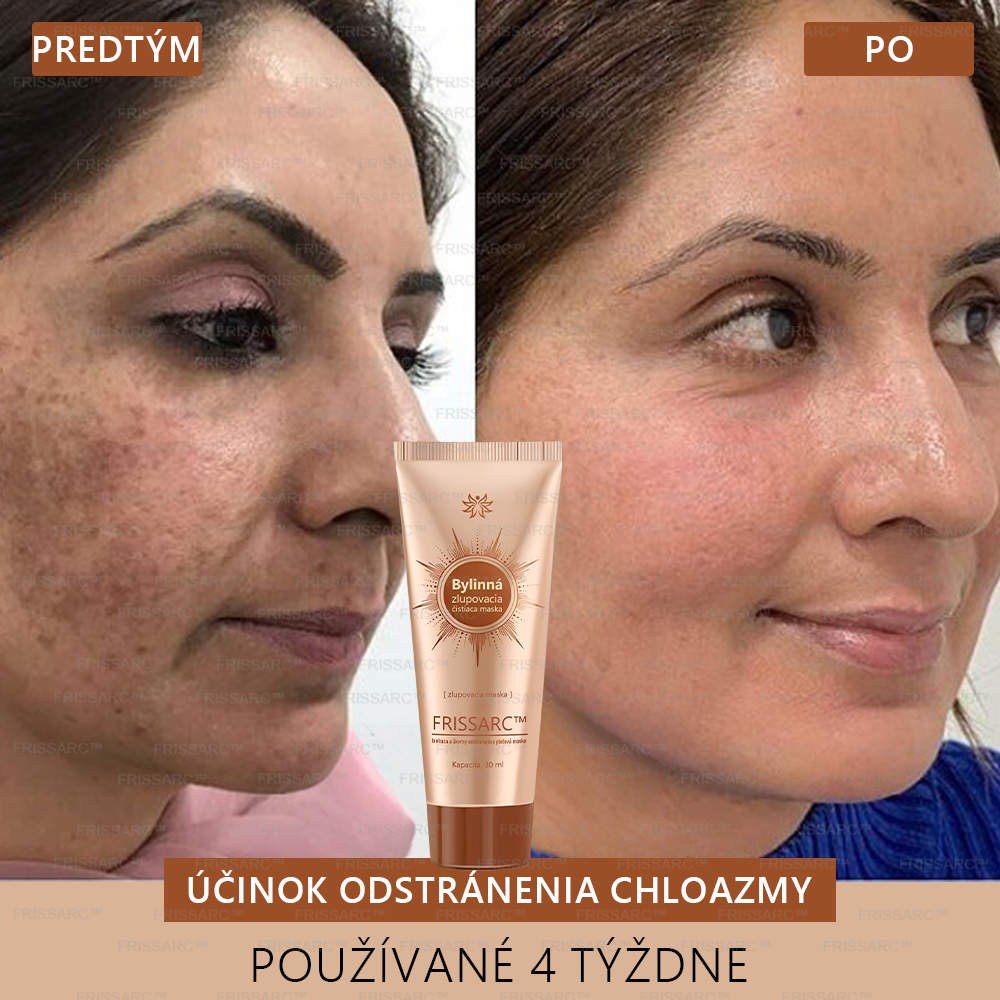 Gratulujeme!💎 Ste jednou z prvých 200 šťastných zákazníčok dneška a získavate špeciálnu zľavu 70 %! Rýchlo odstraňuje pigmentové škvrny a obnovuje mladistvý vzhľad pokožky!