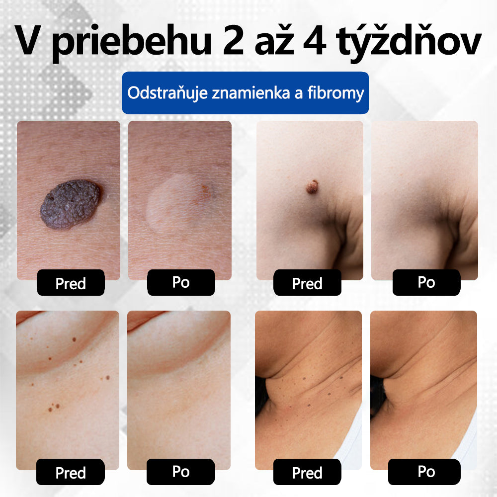 RICPIND®✨ Neinvazívne laserové pero na odstránenie znamienok a bradavíc