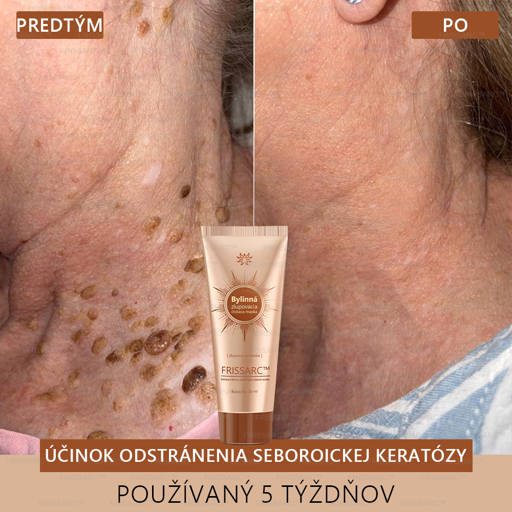 Gratulujeme!💎 Ste jednou z prvých 200 šťastných zákazníčok dneška a získavate špeciálnu zľavu 70 %! Rýchlo odstraňuje pigmentové škvrny a obnovuje mladistvý vzhľad pokožky!