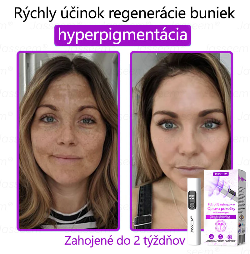 𝐉𝐚𝐬𝐬𝐞𝐞𝐦® ✅Pokročilé neinvazívne CO₂ laserové pero na opravu pokožky 💕 (Jemne odstraňuje bradavice, materské znamienka, starecké škvrny a kožné výrastky – bez bolesti, bez starostí!)