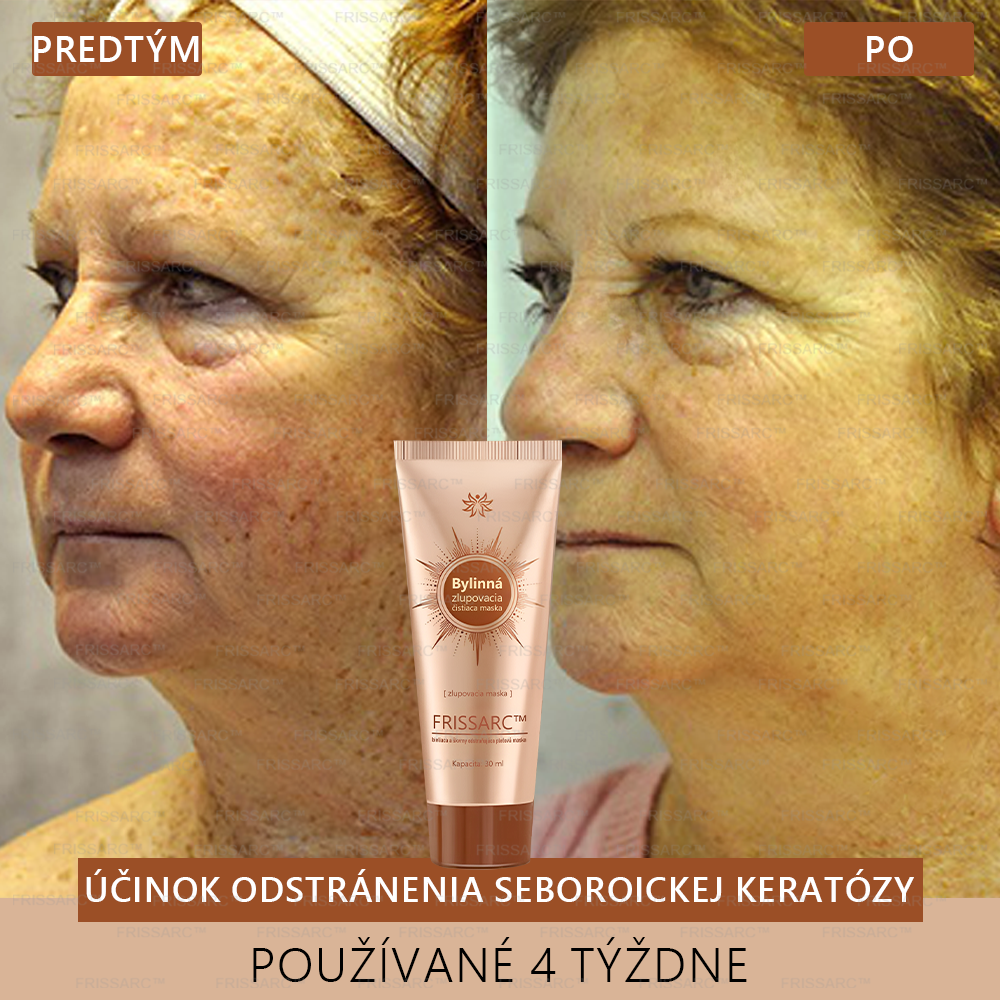 Gratulujeme!💎 Ste jednou z prvých 200 šťastných zákazníčok dneška a získavate špeciálnu zľavu 70 %! Rýchlo odstraňuje pigmentové škvrny a obnovuje mladistvý vzhľad pokožky!
