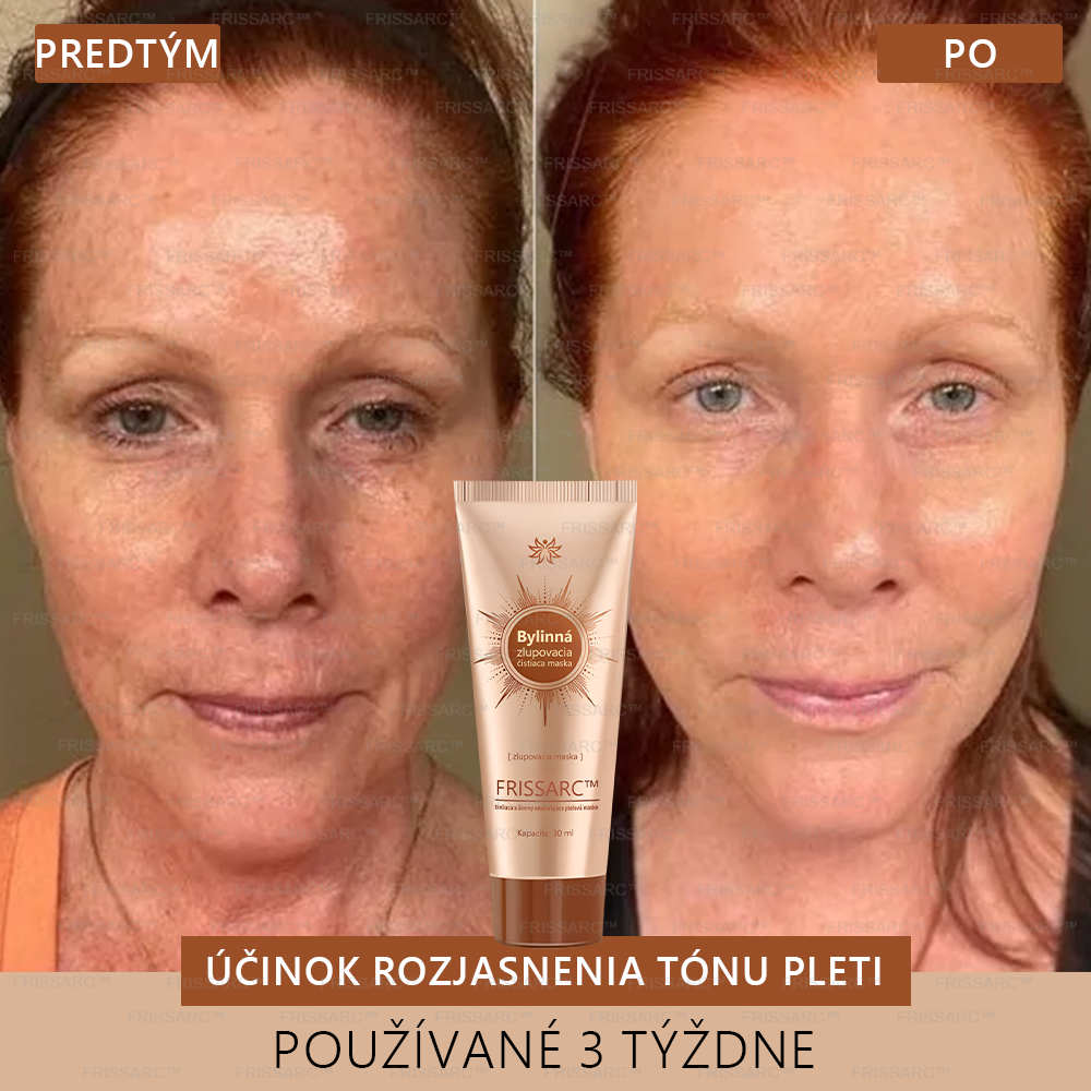 Gratulujeme!💎 Ste jednou z prvých 200 šťastných zákazníčok dneška a získavate špeciálnu zľavu 70 %! Rýchlo odstraňuje pigmentové škvrny a obnovuje mladistvý vzhľad pokožky!