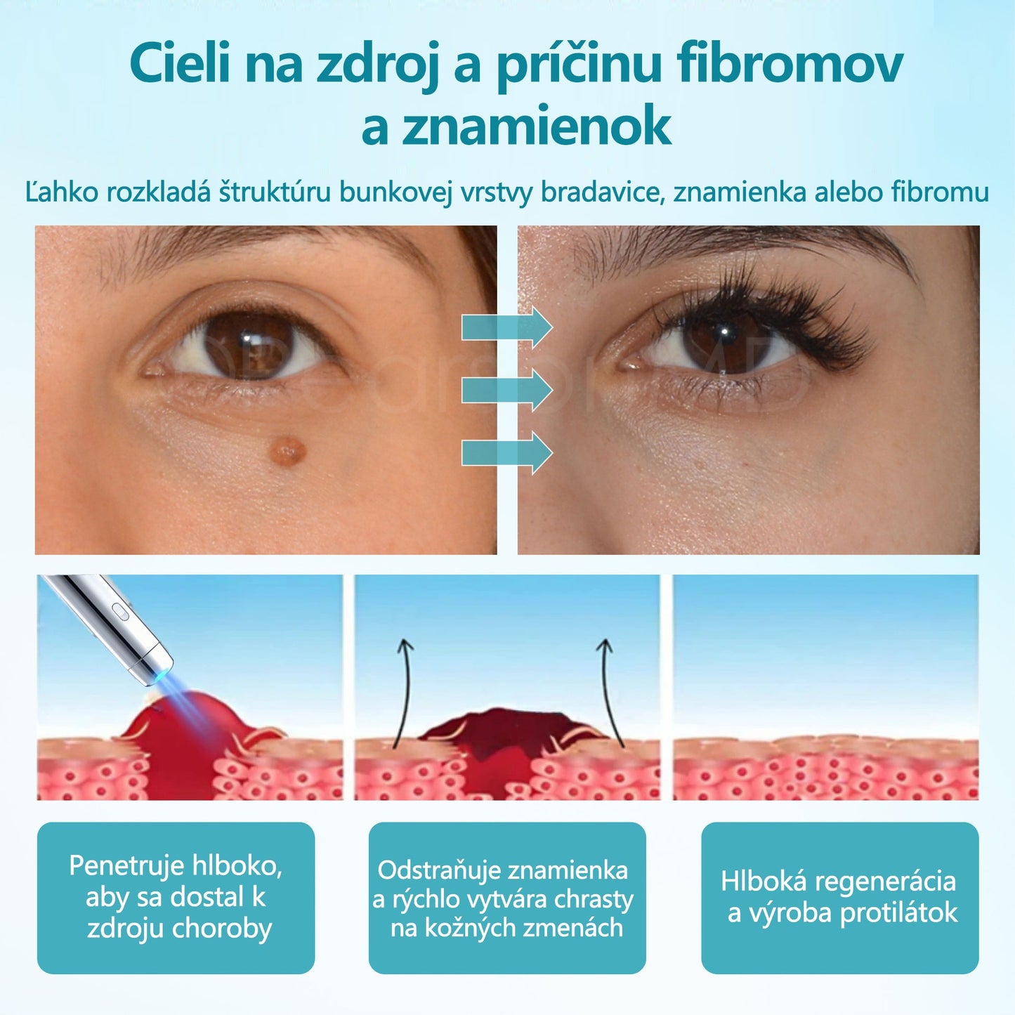 RICPIND®✨ Neinvazívne laserové pero na odstránenie znamienok a bradavíc