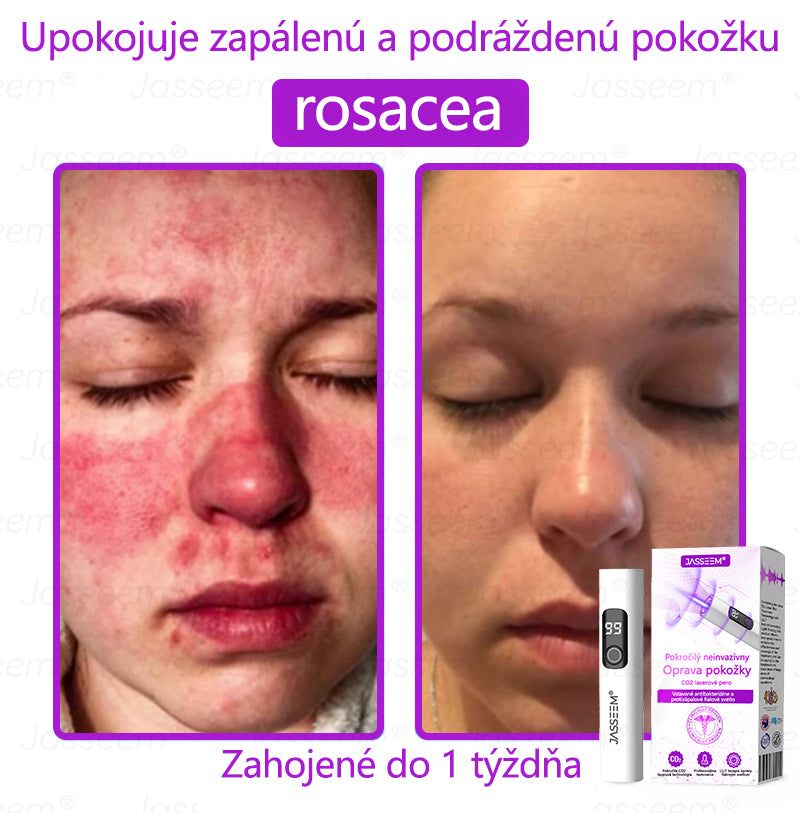 𝐉𝐚𝐬𝐬𝐞𝐞𝐦® ✅Pokročilé neinvazívne CO₂ laserové pero na opravu pokožky 💕 (Jemne odstraňuje bradavice, materské znamienka, starecké škvrny a kožné výrastky – bez bolesti, bez starostí!)