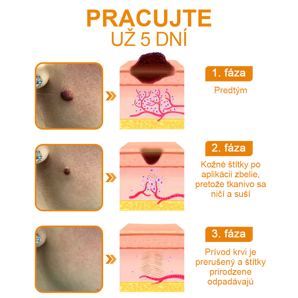 🔥Vsoxa™ Krém na odstránenie bradavíc a krtkov s obsahom včelieho jedu (zľava 80%)