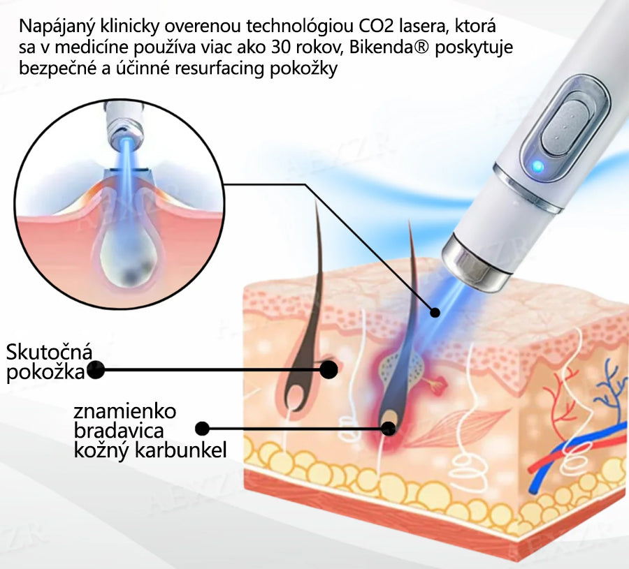 🎉 50 % zľava len na obmedzený čas! Bikenda® Neinvazívne laserové pero Bezbolestné odstránenie znamienok, bradavíc a škvŕn priamo u vás doma! 💕ie znamienok, bradavíc a škvŕn priamo u vás doma! 💕