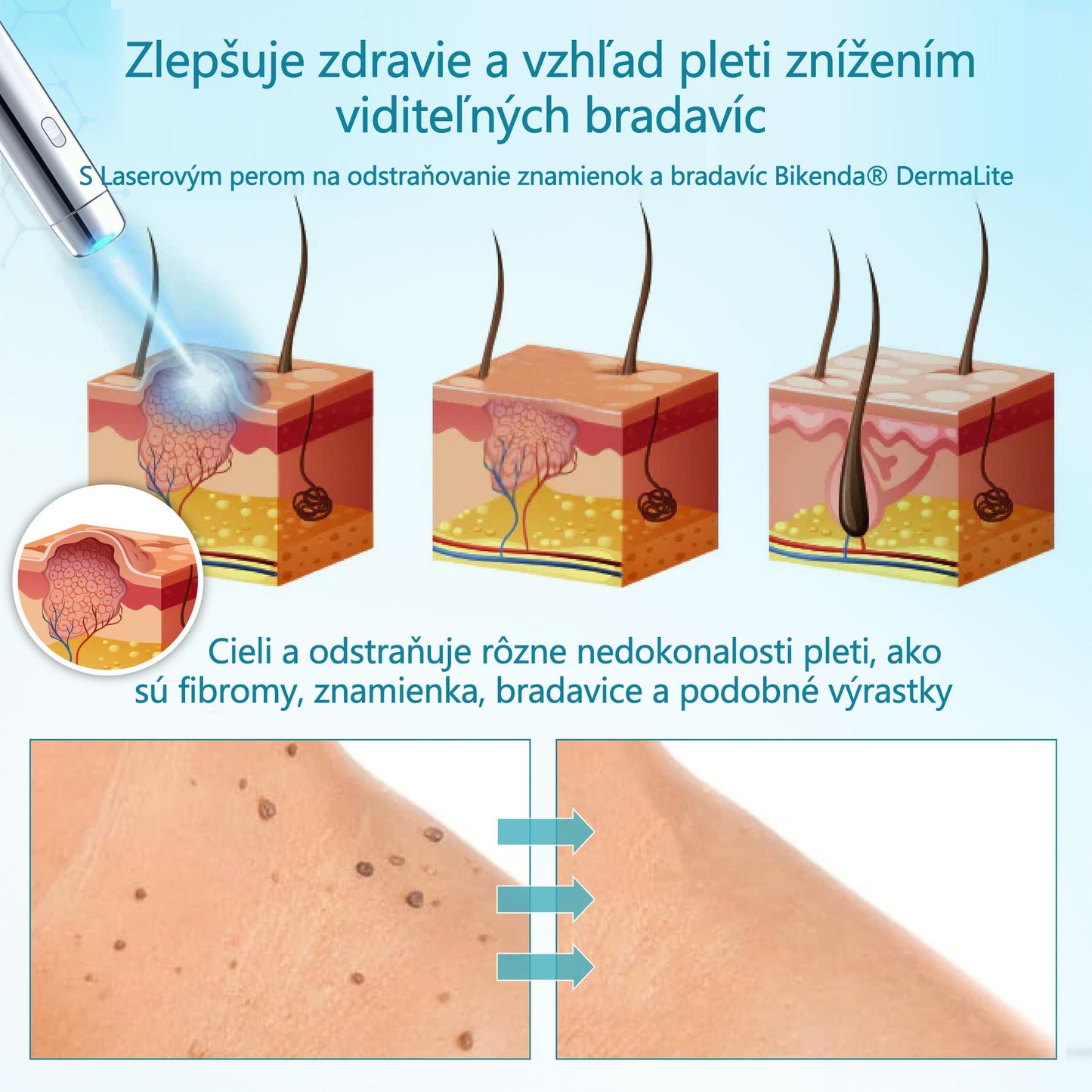 RICPIND®✨ Neinvazívne laserové pero na odstránenie znamienok a bradavíc