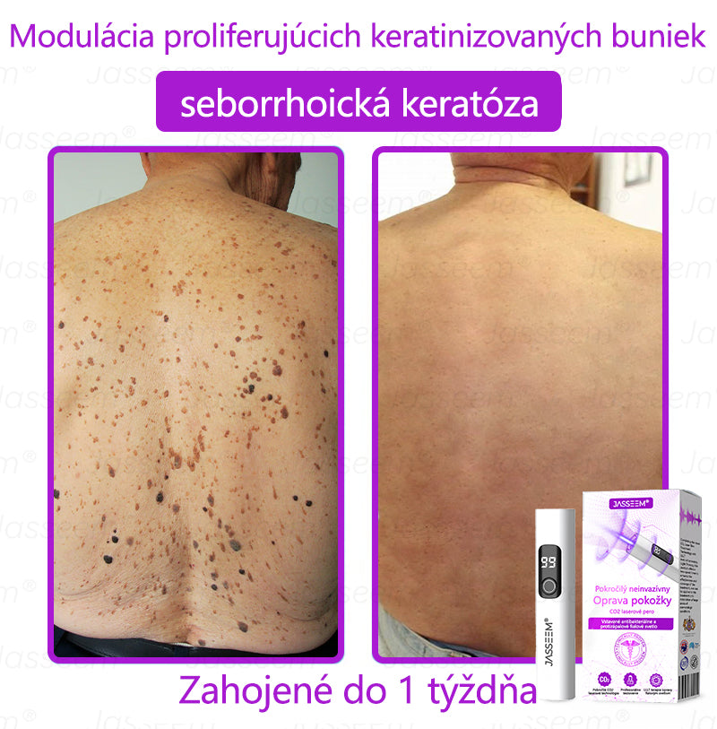 𝐉𝐚𝐬𝐬𝐞𝐞𝐦® ✅Pokročilé neinvazívne CO₂ laserové pero na opravu pokožky 💕 (Jemne odstraňuje bradavice, materské znamienka, starecké škvrny a kožné výrastky – bez bolesti, bez starostí!)