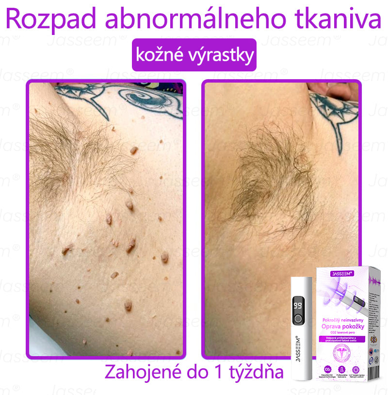 𝐉𝐚𝐬𝐬𝐞𝐞𝐦® ✅Pokročilé neinvazívne CO₂ laserové pero na opravu pokožky 💕 (Jemne odstraňuje bradavice, materské znamienka, starecké škvrny a kožné výrastky – bez bolesti, bez starostí!)