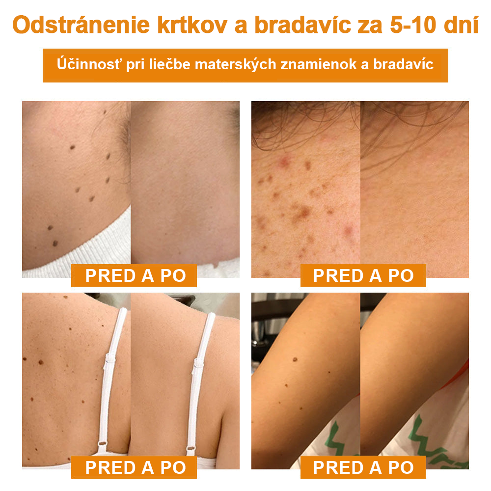 🔥Vsoxa™ Krém na odstránenie bradavíc a krtkov s obsahom včelieho jedu (zľava 80%)