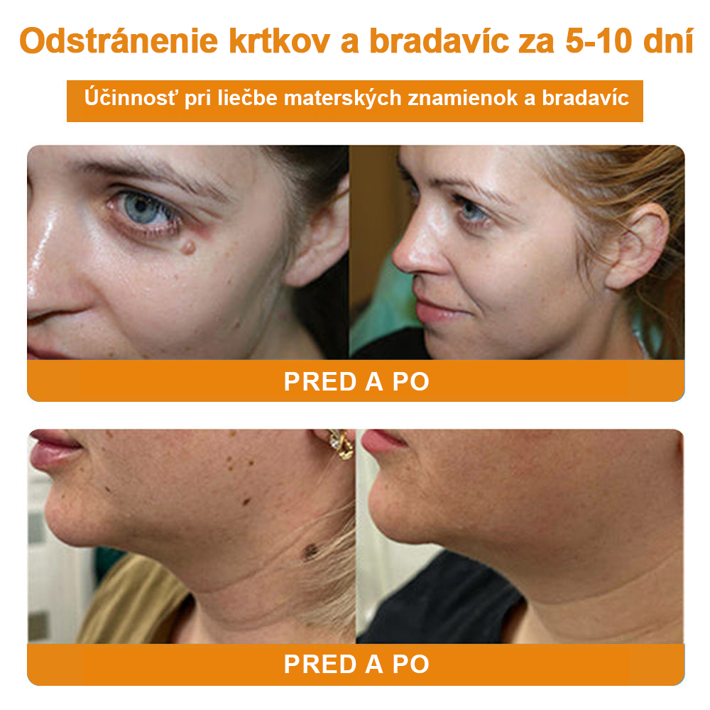 🔥Vsoxa™ Krém na odstránenie bradavíc a krtkov s obsahom včelieho jedu (zľava 80%)