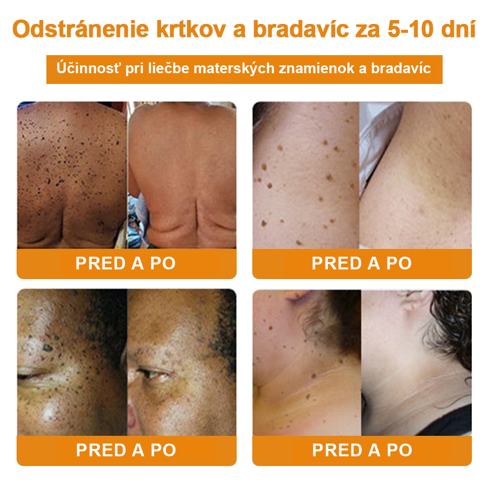 🔥Vsoxa™ Krém na odstránenie bradavíc a krtkov s obsahom včelieho jedu (zľava 80%)