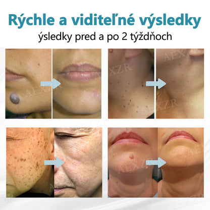 🎉 50 % zľava len na obmedzený čas!  Bikenda® Neinvazívne laserové pero  Bezbolestné odstránenie znamienok, bradavíc a škvŕn priamo u vás doma! 💕ie znamienok, bradavíc a škvŕn priamo u vás doma! 💕