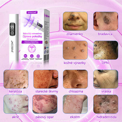𝐉𝐚𝐬𝐬𝐞𝐞𝐦® ✅Pokročilé neinvazívne CO₂ laserové pero na opravu pokožky 💕 (Jemne odstraňuje bradavice, materské znamienka, starecké škvrny a kožné výrastky – bez bolesti, bez starostí!)