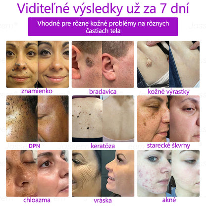 𝐉𝐚𝐬𝐬𝐞𝐞𝐦® ✅Pokročilé neinvazívne CO₂ laserové pero na opravu pokožky 💕 (Jemne odstraňuje bradavice, materské znamienka, starecké škvrny a kožné výrastky – bez bolesti, bez starostí!)