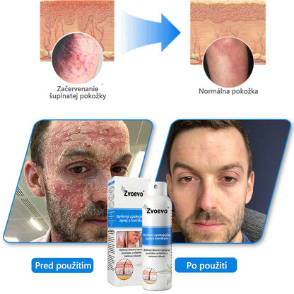Oficiálny obchod✨: Zvoevo®Horčíkový bylinný sprej na psoriázu⚕️certifikované FDA (úľava od psoriázy a ekzému, zlepšenie bakteriálnych infekcií v oblasti genitálií a liečba akné a tmavých škvŕn)