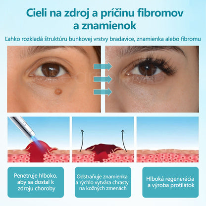 RICPIND®✨ Neinvazívne laserové pero na odstránenie znamienok a bradavíc