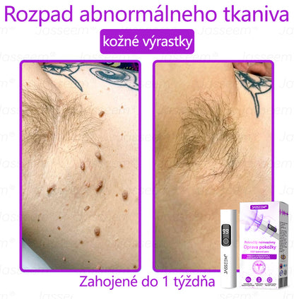 𝐉𝐚𝐬𝐬𝐞𝐞𝐦® ✅Pokročilé neinvazívne CO₂ laserové pero na opravu pokožky 💕 (Jemne odstraňuje bradavice, materské znamienka, starecké škvrny a kožné výrastky – bez bolesti, bez starostí!)